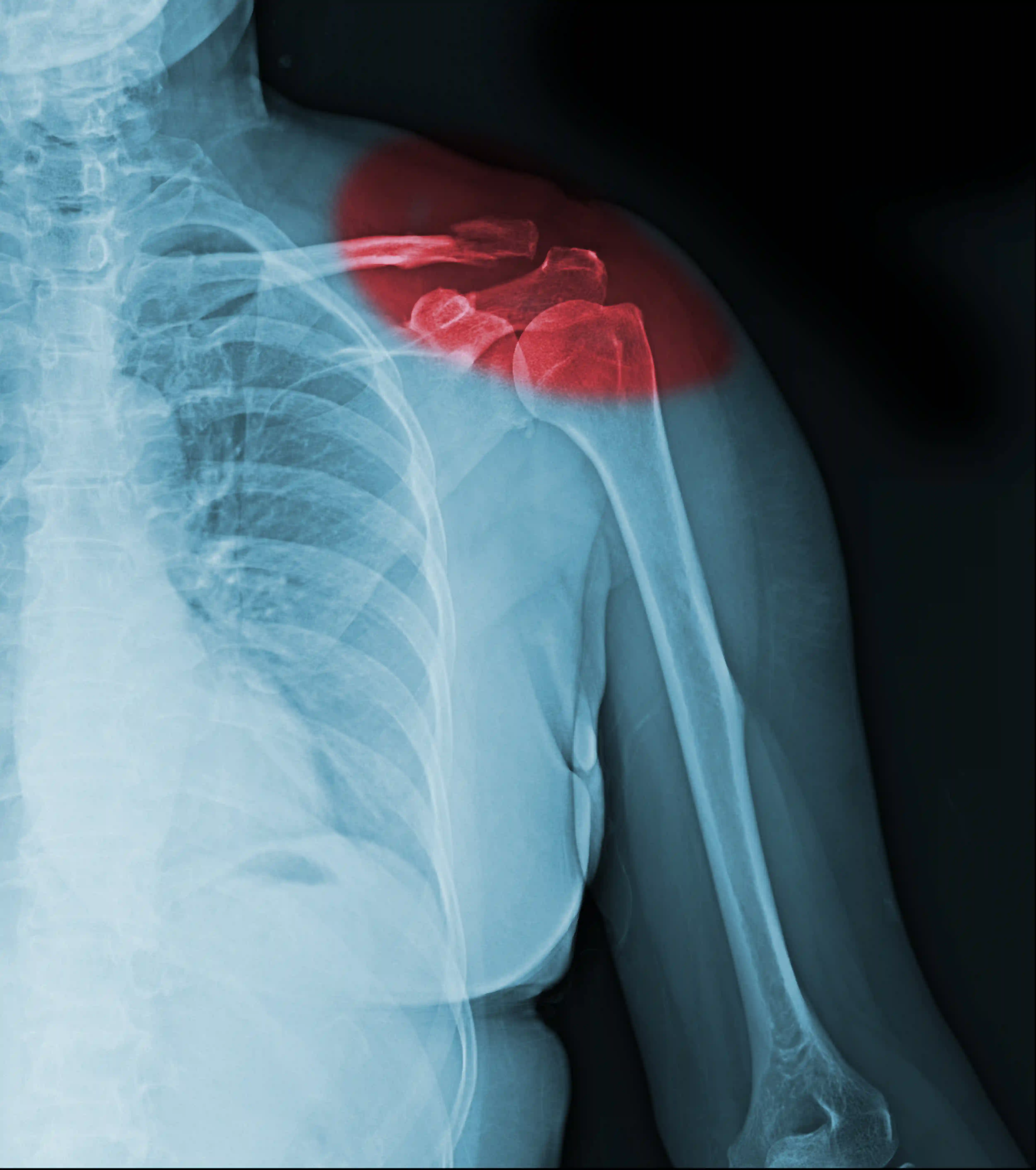 Recurrent Shoulder Dislocation